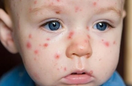 Azərbaycanda koksaki virusunun olduğu təsdiqləndi