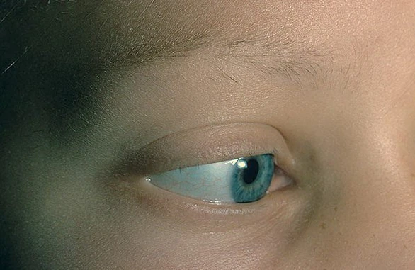 Kirpiklərimiz niyə tökülür?
