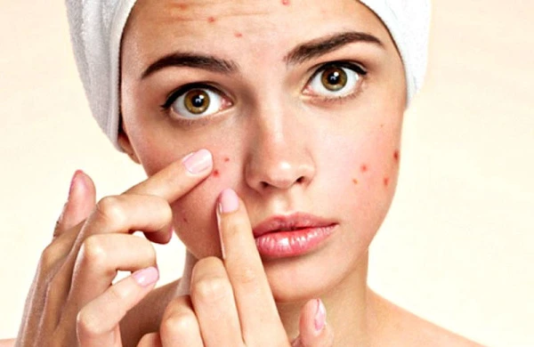 Üzdə yaranan sızanaq və səpgilərin müalicəsi