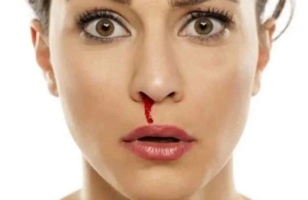 Burun qanaması nədən xəbər verir? - Səbəbləri və müalicəsi