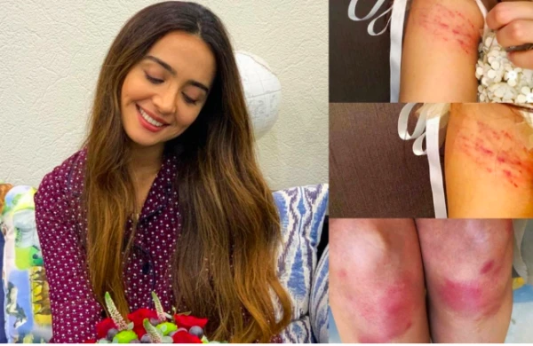 Azərbaycanda məşhur aparıcını bu hala saldılar – Bədənin hər yeri… – FOTOLAR