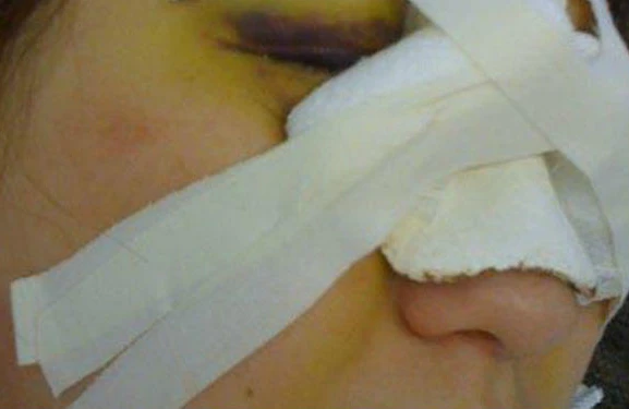 Qısqanc kişi sevgilisinin burnunu YEDİ - FOTO