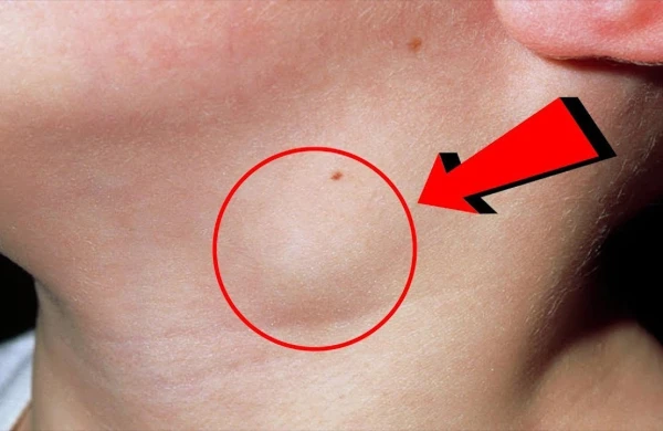 Limfa düyünləri şişən şəxslərdə bu qorxunc xəstəliklər var