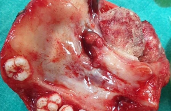 19 yaşlı qızın yumurtalığından çənə sümüyü çıxdı – Azərbaycanda ŞOK 