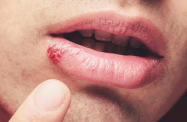 "Koronavirus bədənimizdə herpes kimi əbədi qalsa,insanlıq böyük təhlükədə olacaq" - Rusiyalı patoloqanotom