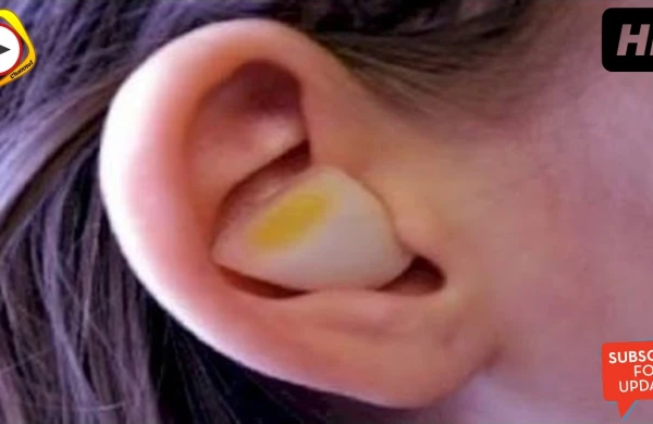 Qulağa soğan parçası qoymaq görün nələr edir ? - VİDEO