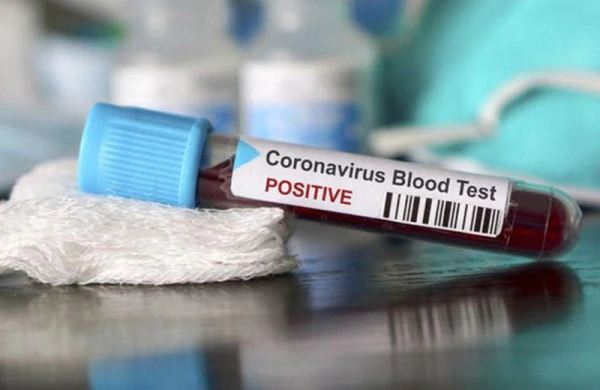 Azərbaycanda indiyədək 9957 nəfər koronavirusa yoluxub, 5583 nəfər müalicə olunaraq sağalıb, 119 nəfər vəfat edib