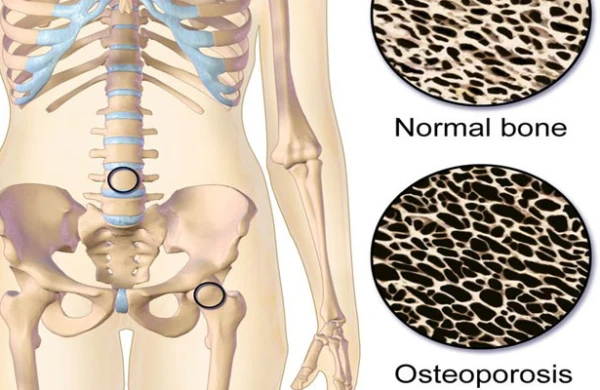 Sümük kütləsinin azalması - OSTEOPOROZ. Səbəblər, simptomlar, müalicə