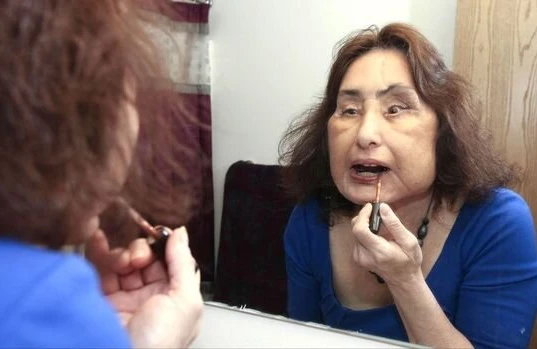ABŞ-da ilk dəfə üz köçürülməsi edilən qadın öldü