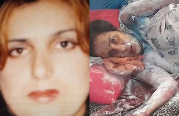 Qayınatası tərəfindən üzünə “kislota” töküldüyü deyilən qadın öldü