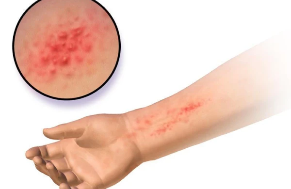 Lateks allergiyası