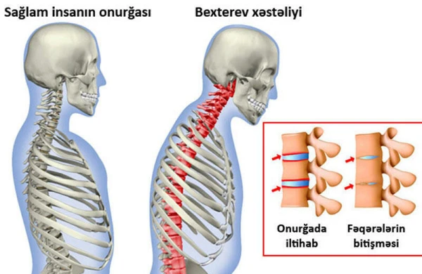 Bexterev xəstəliyi. Hərəkətsiz onurğa