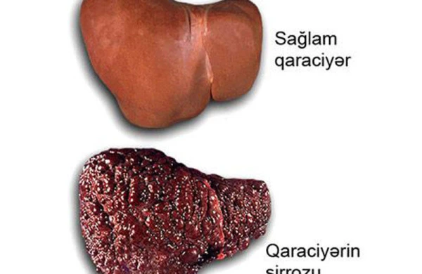 Xəstə qaraciyərin SOS siqnalları