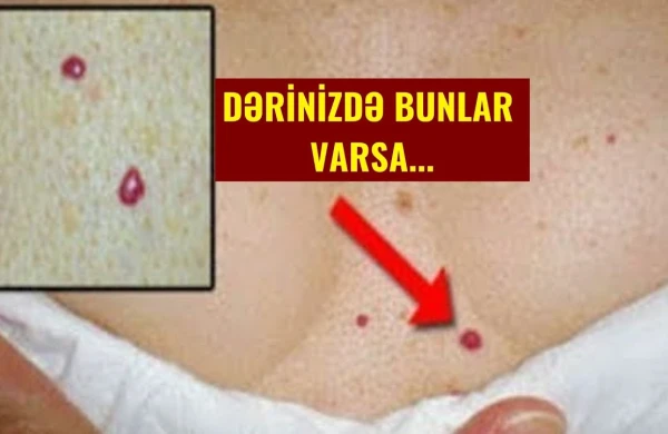 DİQQƏT!!! sizdə bu 10 əlamətdən biri varsa, Ürəyiniz düz işləmir (VİDEO)