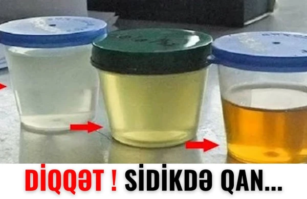 Sidikdə qan bu xəstəliyin əlamətidir - MÜTLƏQ İZLƏ