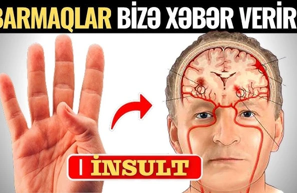 İnsultu Barmaqla Öncədən Biliblər - Paralicin Əlamətləri