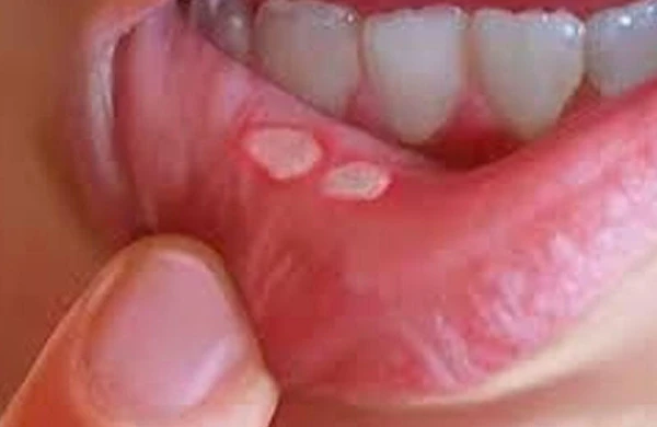 Ağız içində ağrılı yaralar bu vitamin əskikliyindəndir