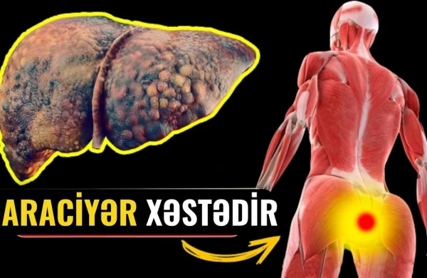 Qaraciyərin Öldüyünü Göstərən 14 Əlamət!