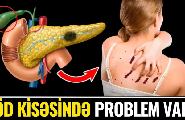 Öd Kisəsinin Məhv Olduğunu Göstərən 7 VACİB ƏLAMƏT