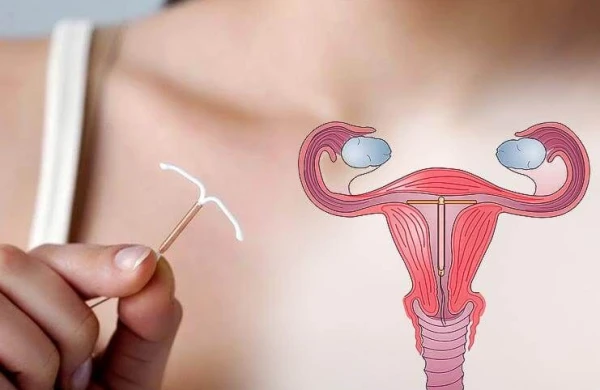 Abort zamanı spiral qoydurmaq olarmı? – Ginekoloqdan açıqlama