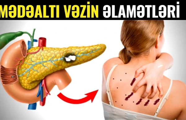 Mədəaltı Vəzin Xəstə Olduğunu Göstərən Əlamətlər +VİDEO