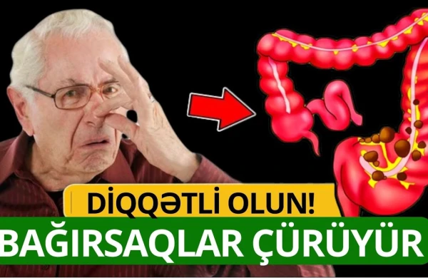 Bağırsaqların Çürüdüyü Göstərən 10 Əlamət! - İnsanların 90%i Bilmir