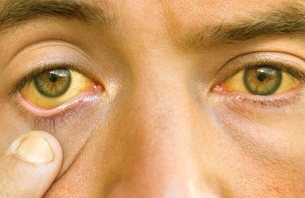 Bu xəstəlik tualetdən yoluxur: Hepatit A - yaranması, əlamətləri