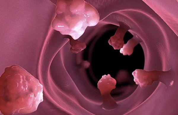 Bağırsaqlarda polip və adenomalar TƏHLÜKƏLİDİR?
