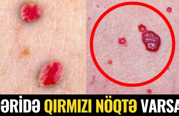 Bədəndə QIRMIZI NÖQTƏLƏR Niyə Təhlükəlidir?- VİDEO