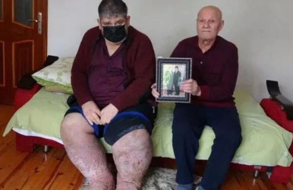 Ağcaqanad dişlədi, öldü - VİDEO - FOTO