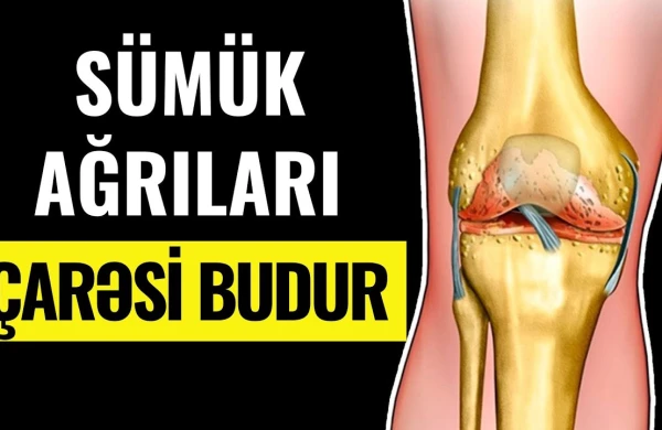 Oynaqlarınız ağrıyırsa baxın! - Sümüklərin bərpası  belə mümkündür