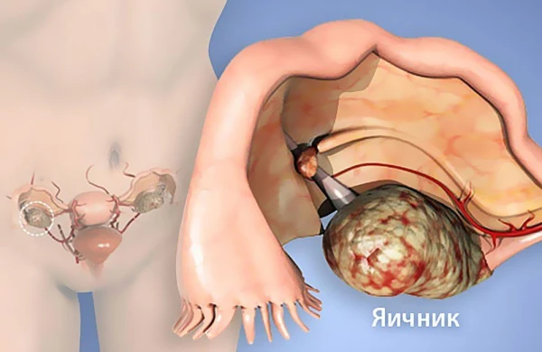 Yumurtalıq xərçənginin 9 qeyri – adi əlaməti - QADINLAR MÜTLƏQ OXUSUN!