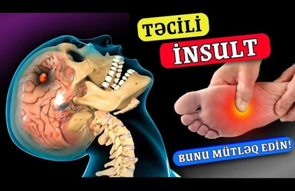 Yaxınlaşan İnsultun 8 ƏLAMƏTİ - Bədən Xəbərdarlıq Edir