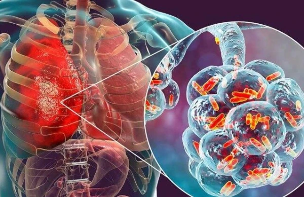 Hovuz və kondisionerlər vasitəsi ilə dəhşətli virus yayılır - 50 yaşdan yuxarı...