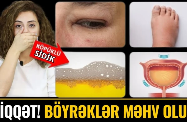 Böyrəklərin Öldüyünü göstərən 10 VACİB ƏLAMƏT