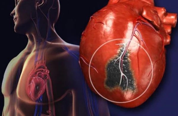Gizli infarkt necə yaranır? - MÜTLƏQ İZLƏYİN 