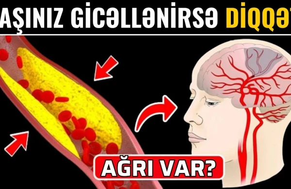 Başgicəllənmə görün hansı xəstəliklərin əlamətidir  -  DİQQƏT!