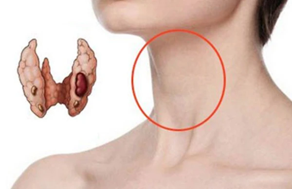 Tənbəl zobun əlamətləri açıqlanıb – endokrinoloqdan xəbərdarlıq&nbsp;&nbsp;