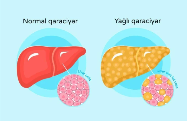 Yağlı qaraciyər xəstəliyinin qarşısını almaq mümkündür – 5 əsas qayda