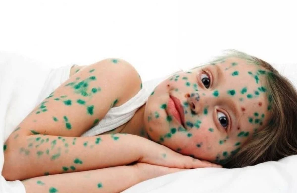 Su çiçəyi zamanı&nbsp; çimmək olarmı? - Həkimdən AÇIQLAMA&nbsp;