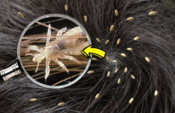 Saç bitini bu yolla təmizləmək mümkündür&nbsp;