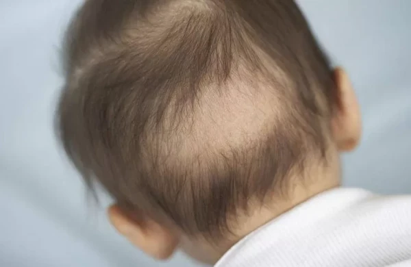 Pediatrdan açıqlama: Uşaqların saçı niyə tökülür?&nbsp;&nbsp;