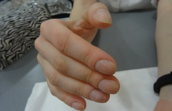 Barmaqlarınızda bu dəyişiklik varsa... Çox təhlükəli simptom