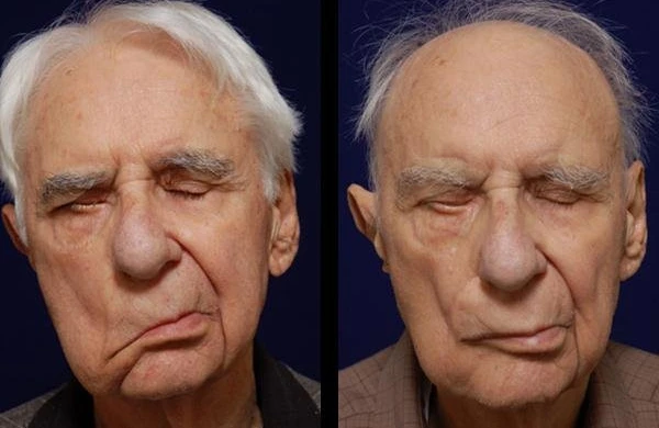 Üst siniri iflici necə müalicə olunur?