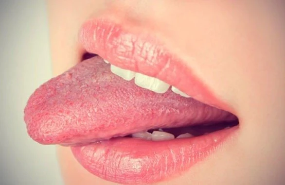 Dilinizə diqqətlə baxın! Bu,ləkələr nədən xəbər verir?