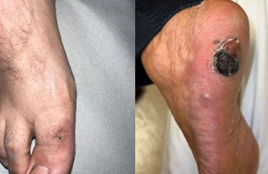 Kapoşi sarkoması nədir?