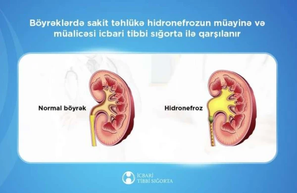 Bu xəstəliyin müalicəsini icbari tibbi sığorta qarşılayır