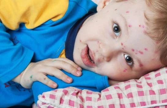 Suçiçəyi ilə bağlı vacib tövsiyə! Bunu etməyin - Həkim AÇIQLADI