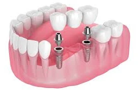 Diş implantının damağa ziyanı varmı? 