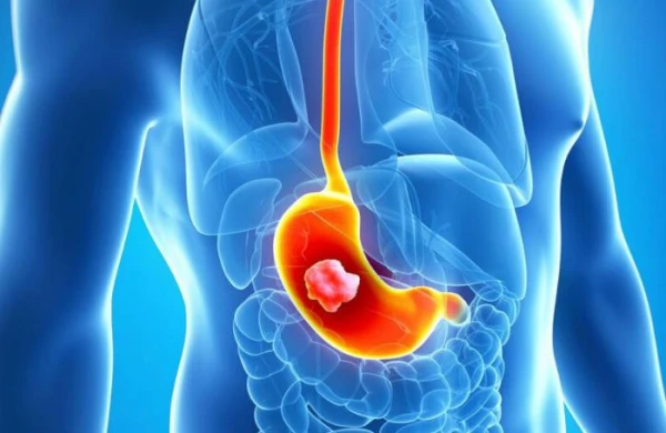 Mədə xərçəngi başlayanda bu əlamətlər görünür&nbsp; - HƏKİM&nbsp; AÇIQLADI